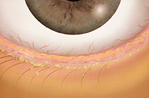 Blepharitis