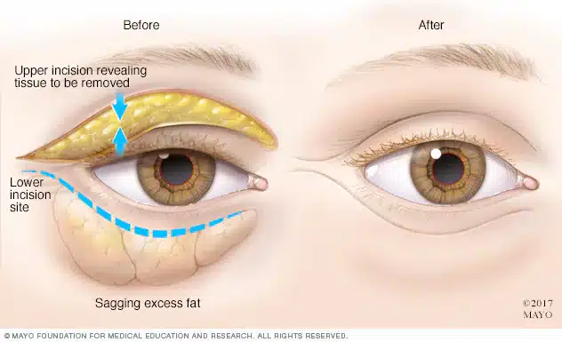 Blepharoplasty Before & After